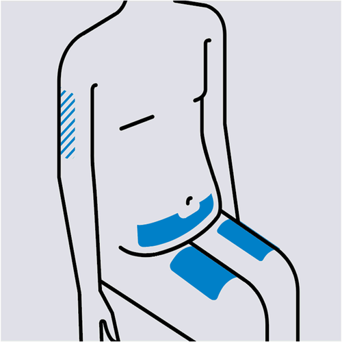 Schizzo di schiena e fianco con indicazione di zone di iniezione sottocutanea evidenziate in blu e cerchiato un punto specifico