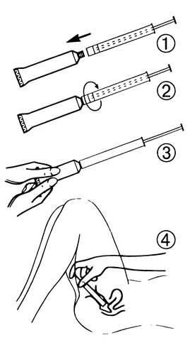 Siringa con ago che mostra le fasi di iniezione sottocutanea, mano che tiene la siringa e area del braccio indicata con cerchio numerato