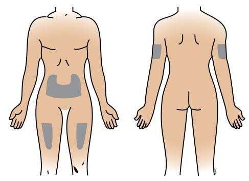 Corpo umano frontale e dorsale con aree ombreggiate che indicano possibili siti di applicazione di cerotti o medicazioni adesive