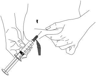 Mano che afferra una siringa prerafillata con ago inserito nella cute, formazione di una piccola bolla e piega cutanea