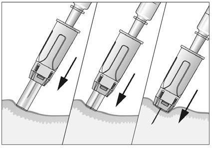 Siringa con ago che penetra nella pelle in tre fasi successive indicate da frecce nere