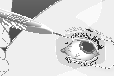 Ago sottile che inietta farmaco nel bulbo oculare con dettagli di palpebre e ciglia circostanti