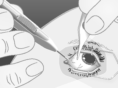 Mano che introduce un ago sottile nell