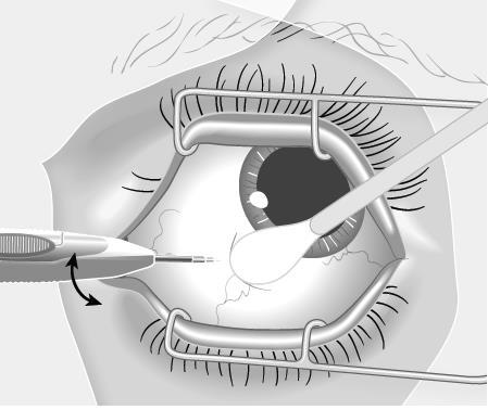 Occhio con palpebre e ciglia tenuto aperto da un divaricatore metallico mentre uno strumento chirurgico esegue un