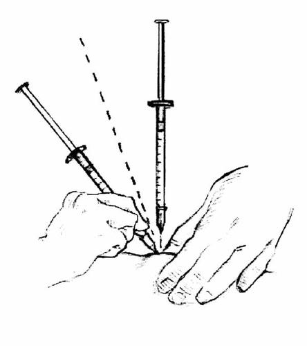 Due mani che tengono una siringa con l