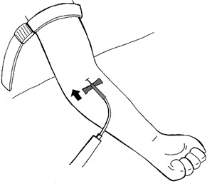 Braccio con laccio emostatico applicato e ago inserito in vena per infusione endovenosa con freccia direzionale