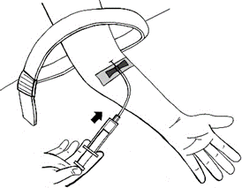 Braccio con laccio emostatico e ago inserito in vena per iniezione, siringa tenuta in mano con freccia indicante direzione