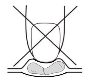 Supposta rettale con due ovali sovrapposti barrata da una croce, indicando di non utilizzare questo metodo di somministrazione