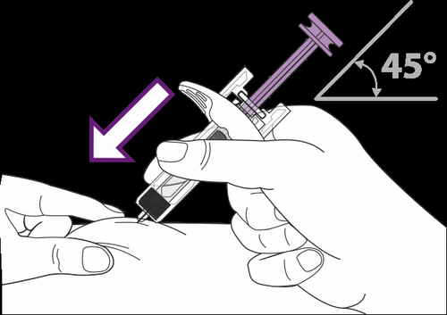 Mano che tiene una siringa preriempita con ago inserito a 45 gradi nella pelle, freccia viola indica la direzione dell