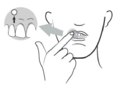 Mano che indica la guancia interna con una freccia proveniente da un molare superiore disegnato in un cerchio