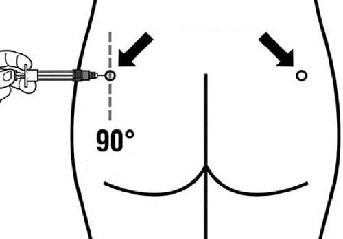 Iniezione sottocutanea nella regione addominale con siringa, frecce indicano il sito e angolo di 90 gradi rispetto alla pelle