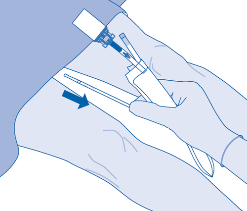 Mano che tiene una siringa preriempita con ago inserito nella coscia, freccia blu indica la direzione dell