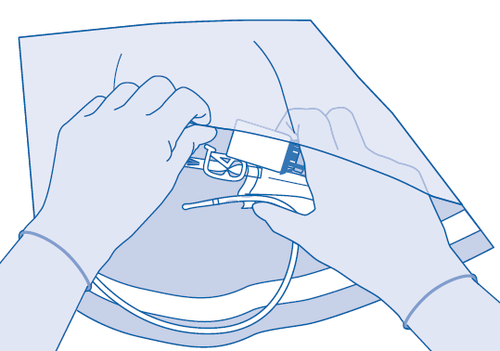 Mano che inserisce un catetere venoso centrale con guida metallica in una vena sotto la pelle del braccio