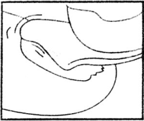 Iniezione sottocutanea mostrata con ago inserito nell
