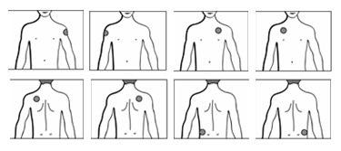 Schema di iniezioni intramuscolari su torso umano con cerchi che indicano i siti di somministrazione su spalle e fianchi