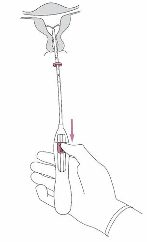 Mano che tiene un applicatore intravaginale con stelo e cilindro rosa, freccia indica la pressione sul pulsante