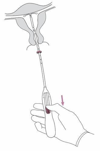 Dispositivo intrauterino a forma di T inserito nell