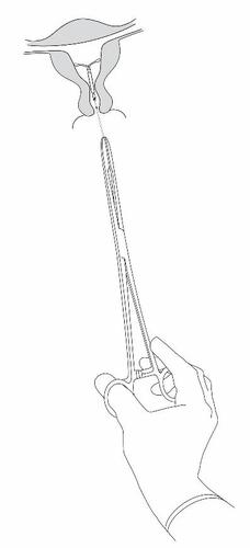 Mano che impugna una pinza chirurgica che afferra un filo sottile che emerge da un tessuto anatomico stilizzato