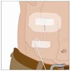 Cerotto medico adesivo applicato sull