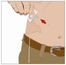 Iniezione sottocutanea nell