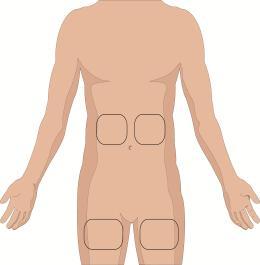 Schema del corpo umano con evidenziate le aree di iniezione sottocutanea su fianchi e cosce