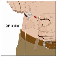 Mano che inserisce un ago sottocutaneo con un angolo di 90 gradi nella pelle dell