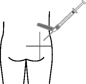 Iniezione sottocutanea nella coscia con ago inclinato e punto di iniezione evidenziato da croci