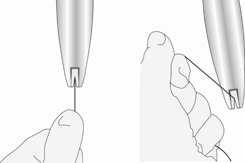 Mano che stringe un dito con filo chirurgico mentre una pinza tiene il filo per facilitare il posizionamento