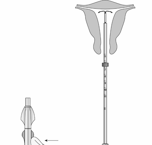 Siringa pre-riempita con stantuffo graduato da 5 a 11 e ago di iniezione collegato lateralmente