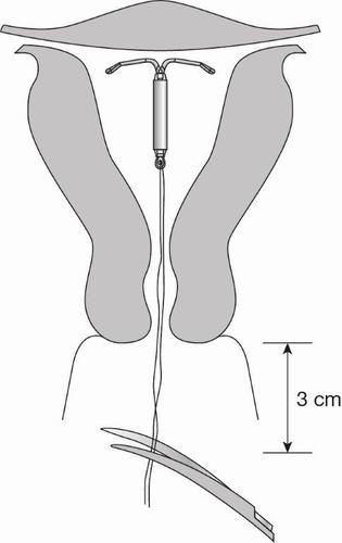 Dispositivo intrauterino a forma di T posizionato all