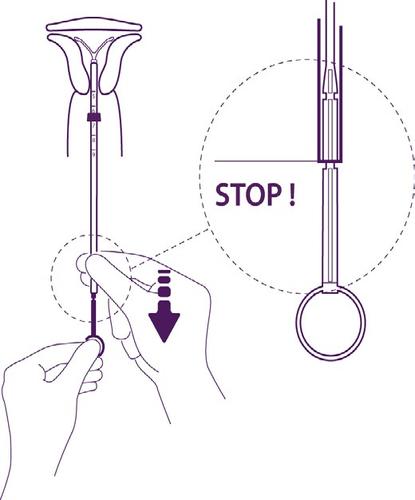 Dispositivo intrauterino con marcatore e filo di trazione inserito nell