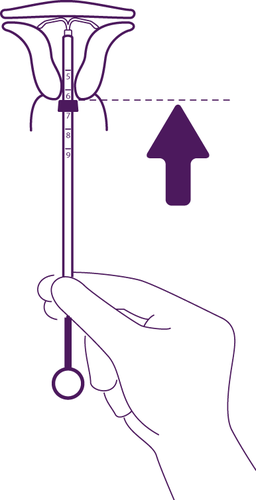 Dispositivo intrauterino a forma di T tenuto da una mano con freccia direzionale verso l
