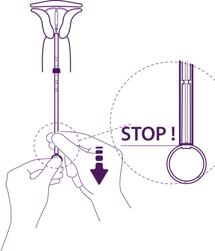 Dispositivo intrauterino a forma di T con indicazioni numeriche e freccia verso il basso che indica il punto di inserimento corretto