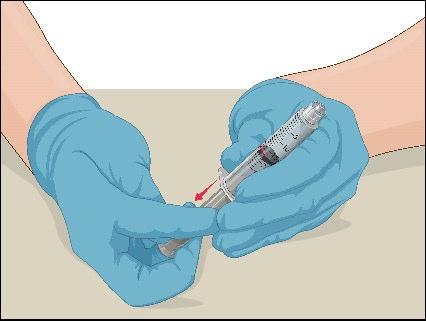 Mano con guanto blu che tiene una siringa preriempita con farmaco e ago inserito nel tessuto sottocutaneo con freccia rossa indicante la direzione