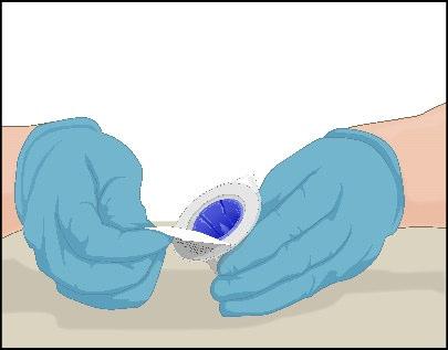 Mani con guanti azzurri che applicano un cerotto medicinale bianco su una zona di pelle chiara