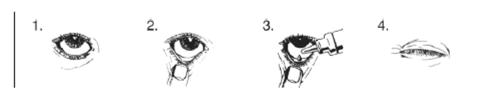 Occhio che mostra diverse fasi di applicazione di gocce oculari da un flacone contagocce
