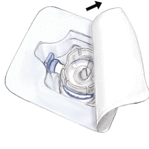 Cerotto medico con dispositivo di infusione sottocutanea applicato, parte del cerotto sollevata per mostrare il meccanismo