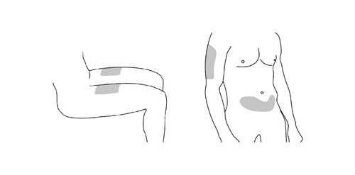 Schizzo di due figure umane laterali con aree ombreggiate che indicano possibili siti di iniezione sottocutanea su coscia e addome