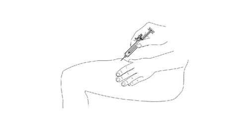 Mano che tiene una siringa con ago inserito nella cute del braccio, tecnica di iniezione sottocutanea illustrata con linee schematiche