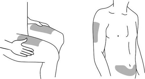 Schizzo di una persona con aree ombreggiate che indicano possibili siti di iniezione sottocutanea su coscia, braccio e addome