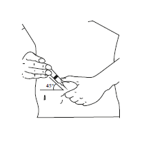 Mano che tiene una siringa inclinata a 45 gradi mentre inietta un farmaco nel braccio di un paziente con la pelle segnata