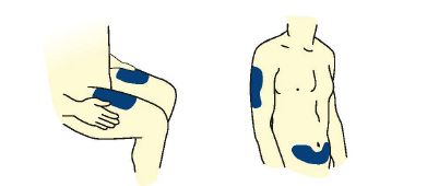 Corpo umano stilizzato con aree evidenziate in blu per iniezioni sottocutanee su braccio, fianco e addome