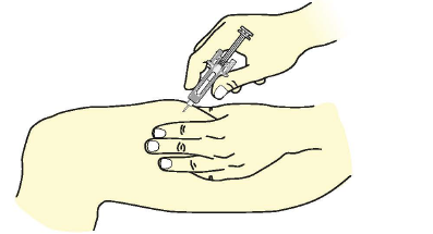 Mano che tiene una siringa con ago inserito nella pelle, tecnica di iniezione sottocutanea con angolo di circa 45 gradi