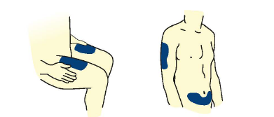 Corpo umano stilizzato con aree evidenziate in blu su braccio, fianco e addome indicanti possibili siti di iniezione