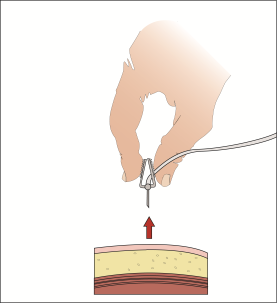 Mano che tiene una penna iniettabile con ago rivolto verso il basso su strati di pelle e tessuto muscolare con freccia rossa