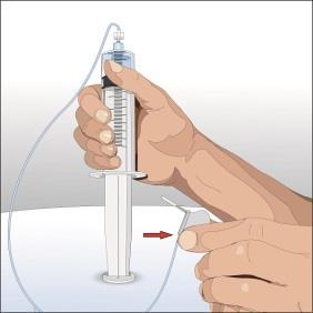 Mano che tiene una siringa con ago inserito nella pelle, freccia rossa indica la direzione di iniezione, tubicino trasparente collegato