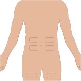 Schiena umana stilizzata con evidenziate aree rettangolari per iniezioni sottocutanee su fianchi e addome