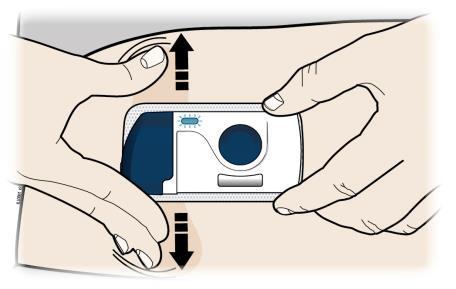 Mani che applicano un cerotto medicinale adesivo con un meccanismo di rilascio blu su pelle chiara frecce indicano la direzione