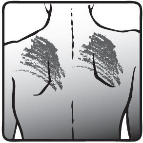 Schiena umana stilizzata con indicazione delle aree di iniezione intramuscolare ai lati della colonna vertebrale