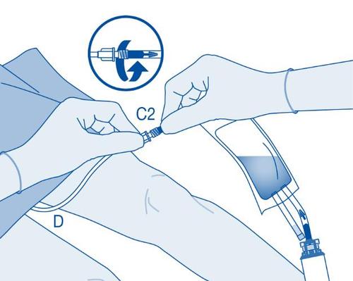 Mani che collegano un dispositivo medico a un sacchetto per infusione con freccia circolare e indicazioni C2 e D